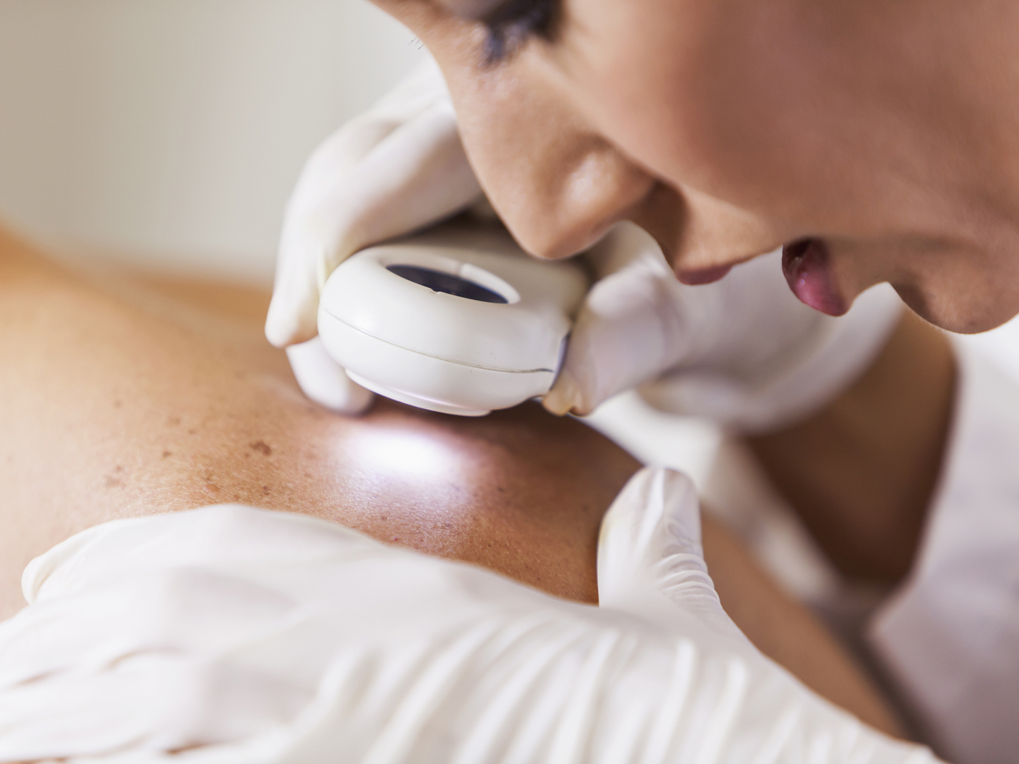 皮肤科女医生(30多岁)正在用皮肤镜检查男性患者的皮肤，仔细观察痣是否有皮肤癌的迹象。