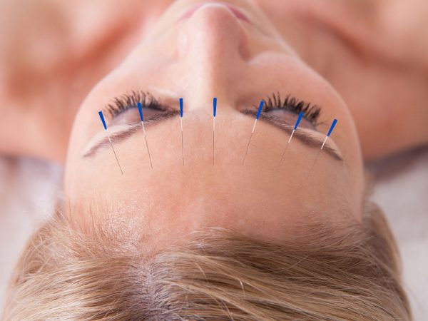 针灸可能有助于减轻紧张性头痛